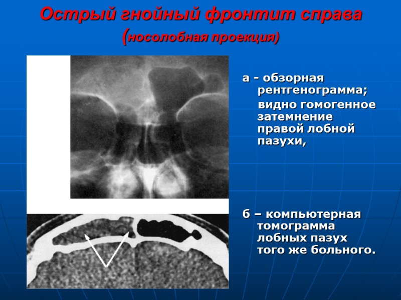 Острый гнойный фронтит справа (носолобная проекция) а - обзорная рентгенограмма;    